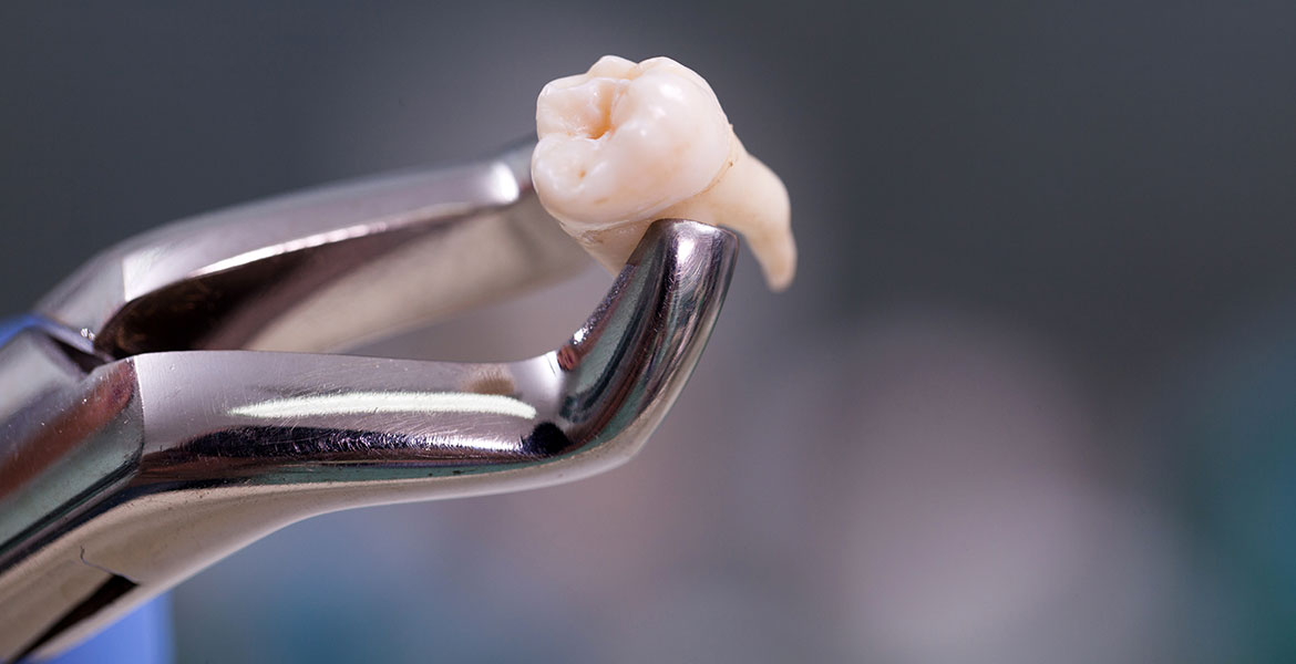 A Wisdom Tooth Removed in Brisbane